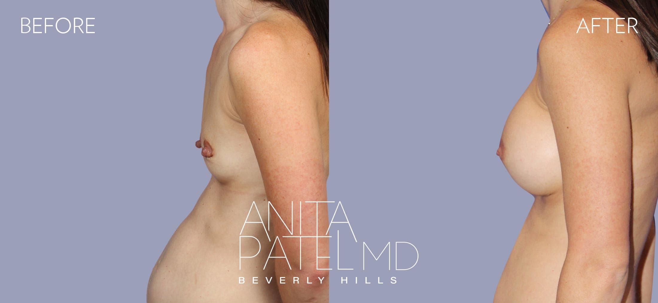 Breast Augmentation before and after — Patient 14, photo 5 of 5 — Dr. Anita Patel, MD, FACS, Beverly Hills