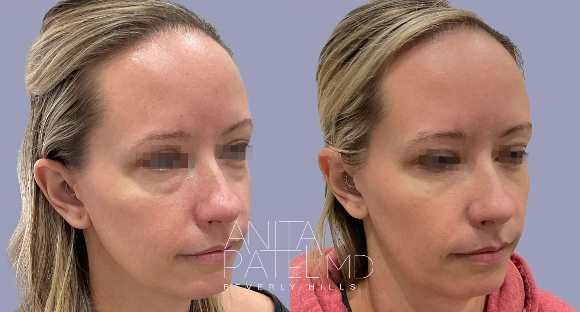 Eyelid Lift before and after — Dr. Anita Patel, Beverly Hills