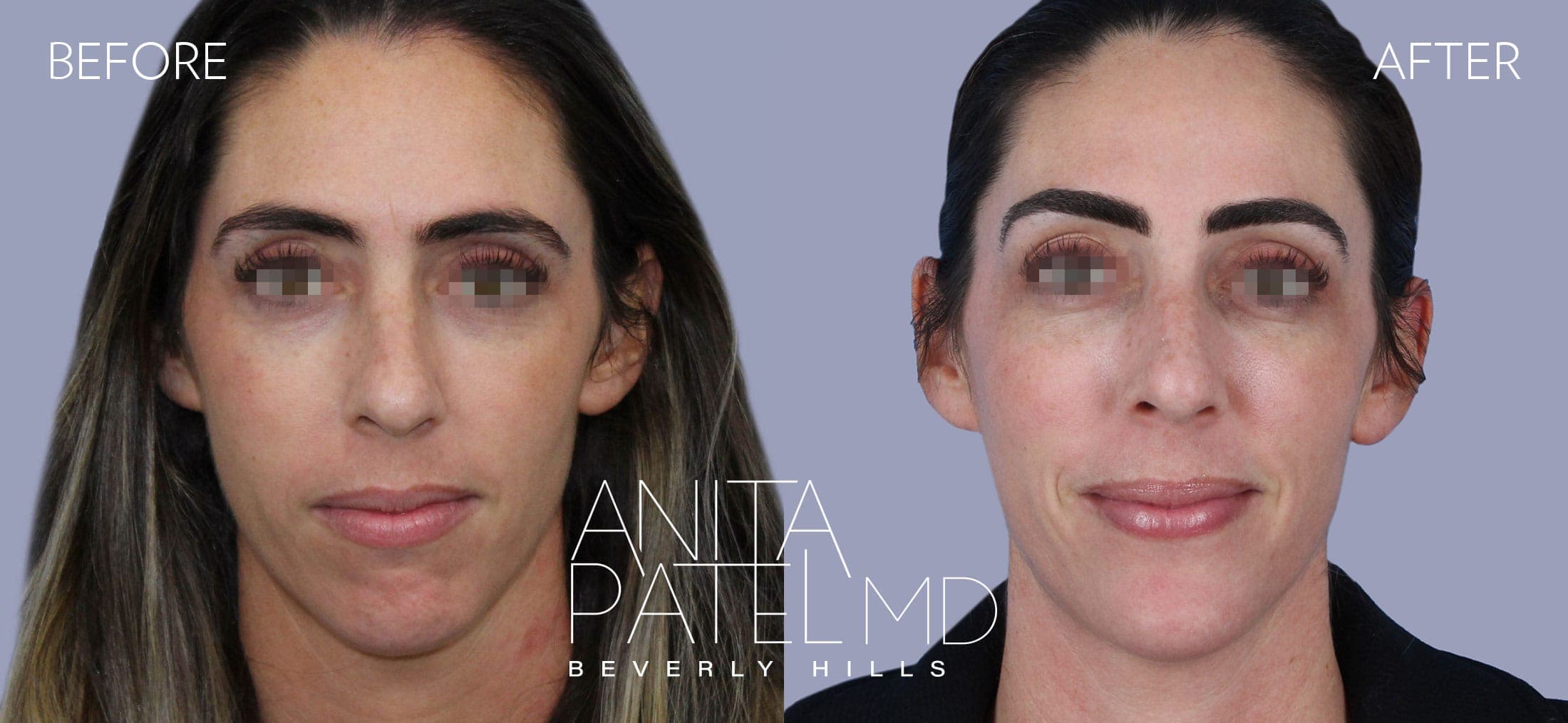 Liquid Makeover® before and after — Patient 1, photo 1 of 4 — Dr. Anita Patel, MD, FACS, Beverly Hills