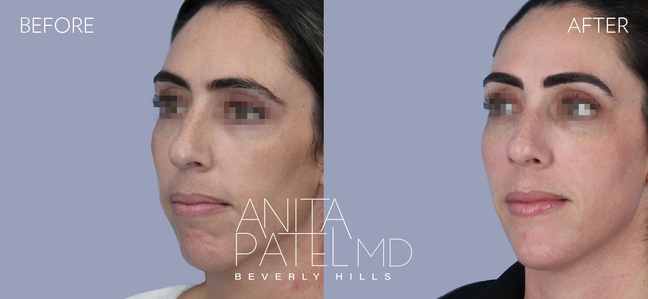 Dermal Fillers before and after — Dr. Anita Patel, Beverly Hills