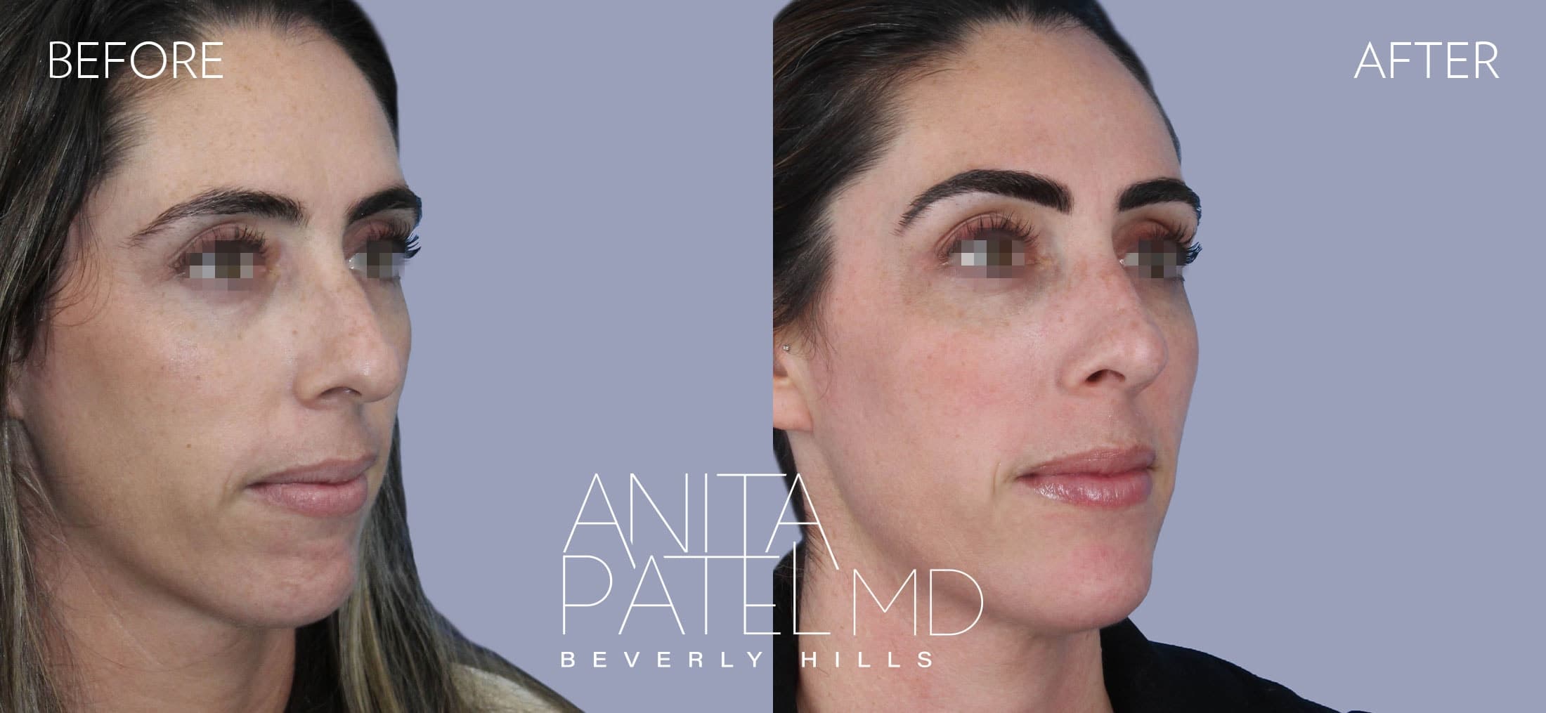 Dermal Fillers before and after — Patient 1, photo 2 of 4 — Dr. Anita Patel, MD, FACS, Beverly Hills