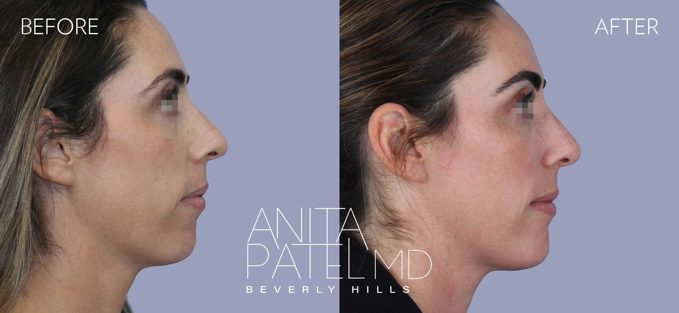 Dermal Fillers before and after — Patient 1, photo 3 of 4 — Dr. Anita Patel, MD, FACS, Beverly Hills