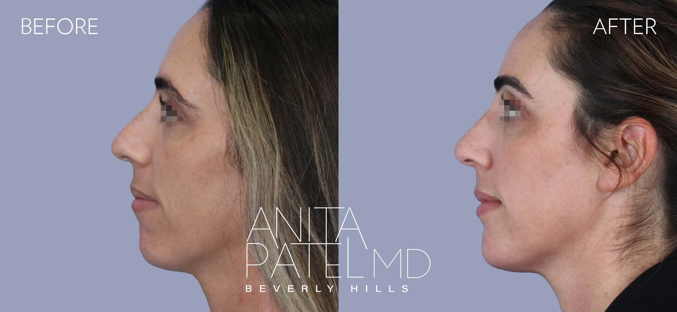 Dermal Fillers before and after — Patient 1, photo 4 of 4 — Dr. Anita Patel, MD, FACS, Beverly Hills