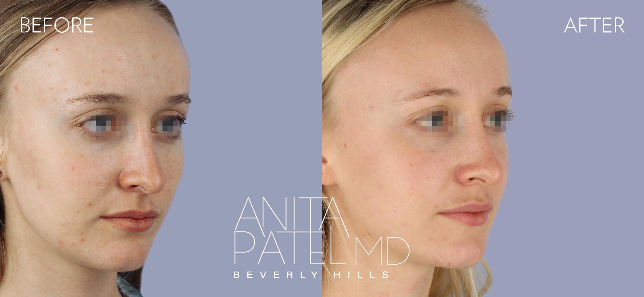 Dermal Fillers before and after — Patient 4, photo 2 of 5 — Dr. Anita Patel, MD, FACS, Beverly Hills