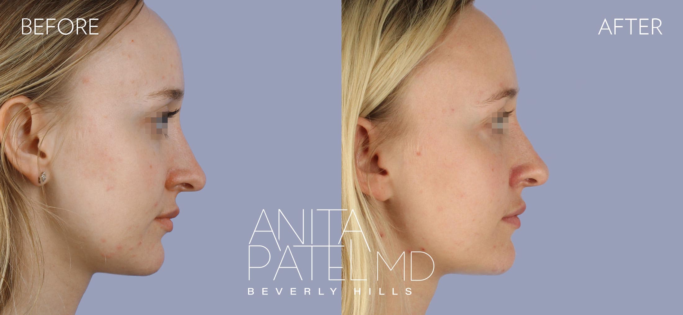 Dermal Fillers before and after — Patient 4, photo 3 of 5 — Dr. Anita Patel, MD, FACS, Beverly Hills