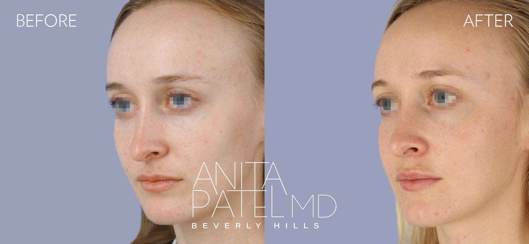 Dermal Fillers before and after — Patient 4, photo 4 of 5 — Dr. Anita Patel, MD, FACS, Beverly Hills