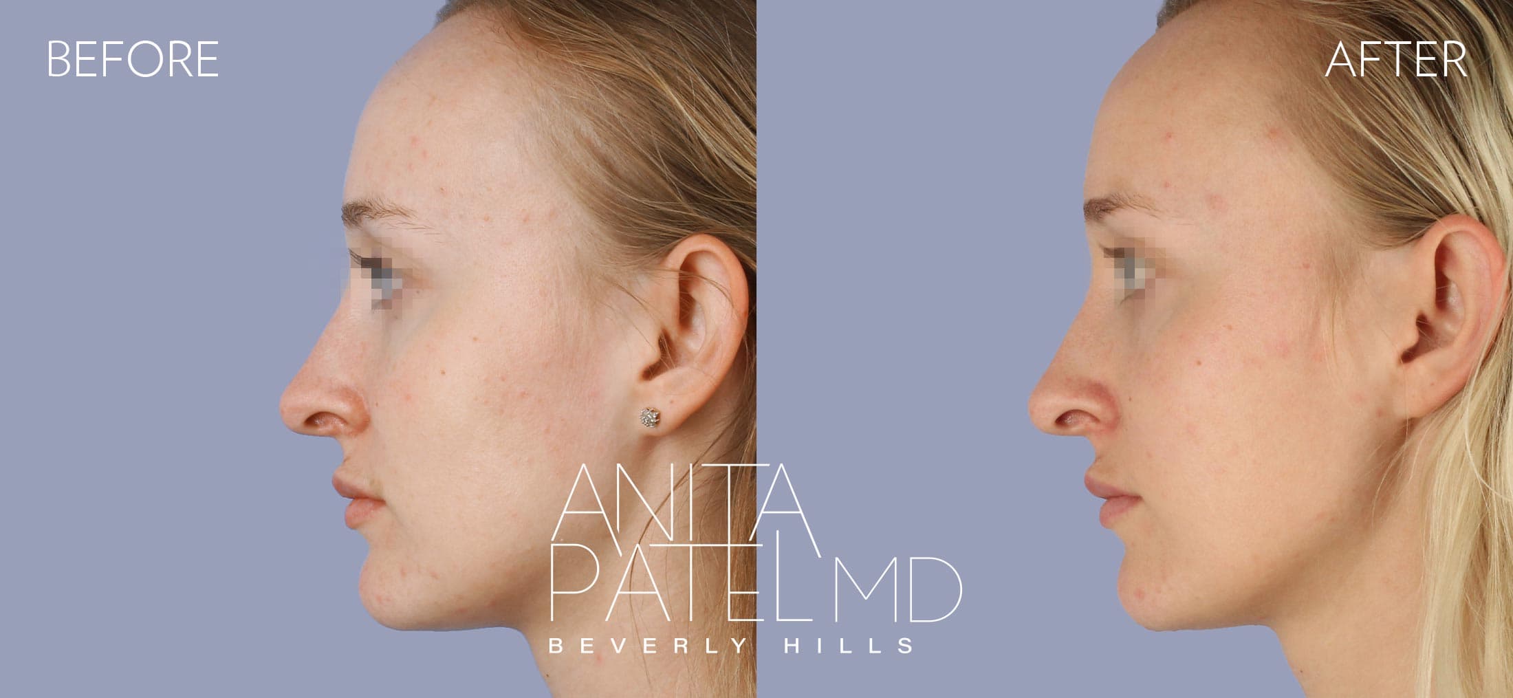 Dermal Fillers before and after — Patient 4, photo 5 of 5 — Dr. Anita Patel, MD, FACS, Beverly Hills