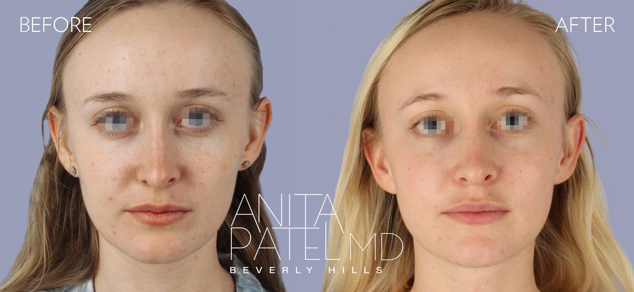Dermal Fillers before and after — Patient 4, photo 1 of 5 — Dr. Anita Patel, MD, FACS, Beverly Hills
