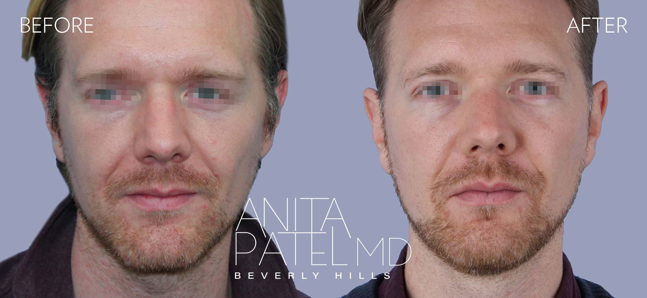 Dermal Fillers before and after — Patient 5, photo 1 of 5 — Dr. Anita Patel, MD, FACS, Beverly Hills