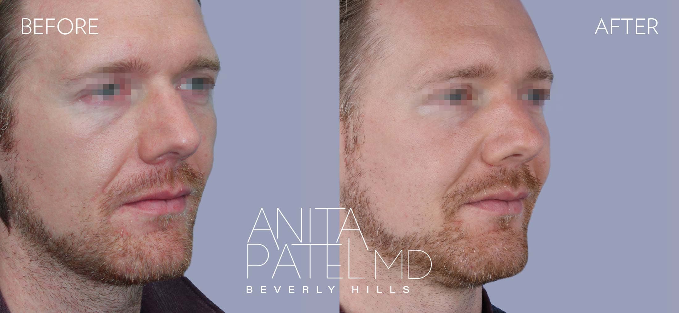 Dermal Fillers before and after — Patient 5, photo 2 of 5 — Dr. Anita Patel, MD, FACS, Beverly Hills