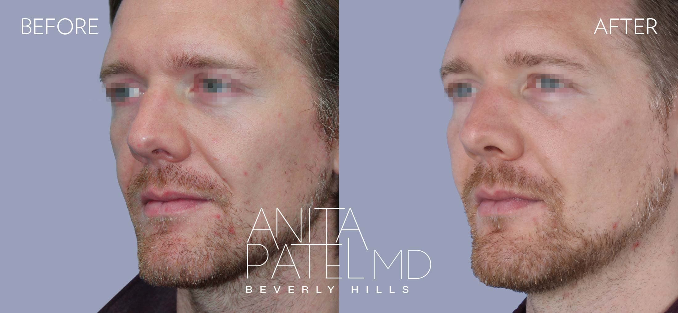 Dermal Fillers before and after — Patient 5, photo 4 of 5 — Dr. Anita Patel, MD, FACS, Beverly Hills