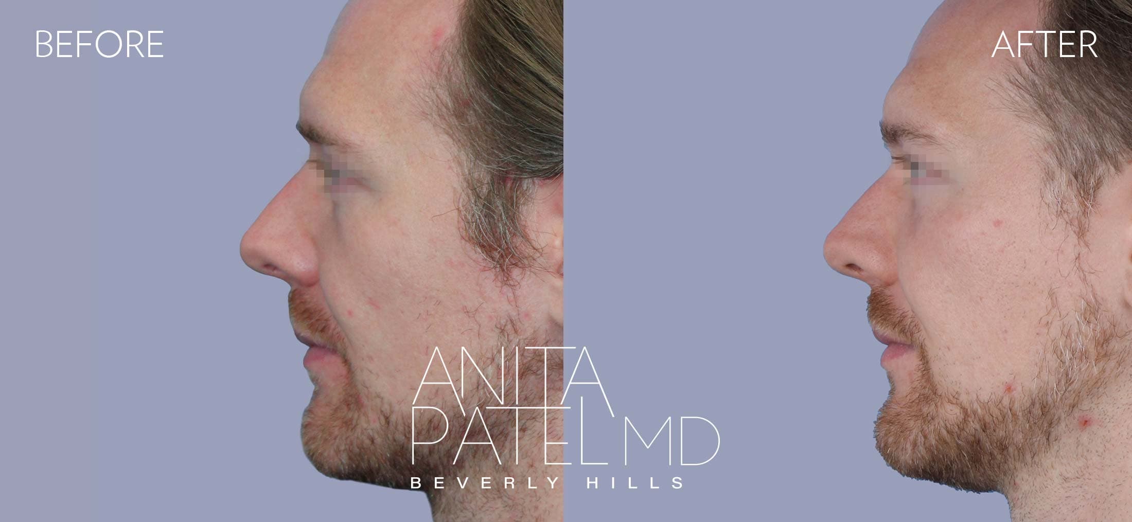 Dermal Fillers before and after — Patient 5, photo 5 of 5 — Dr. Anita Patel, MD, FACS, Beverly Hills