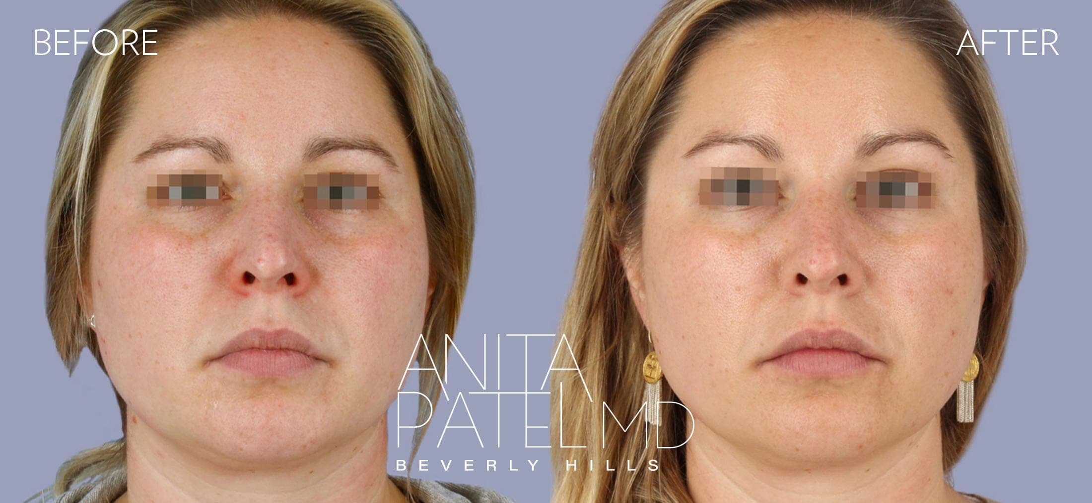Dermal Fillers before and after — Patient 7, photo 1 of 2 — Dr. Anita Patel, MD, FACS, Beverly Hills