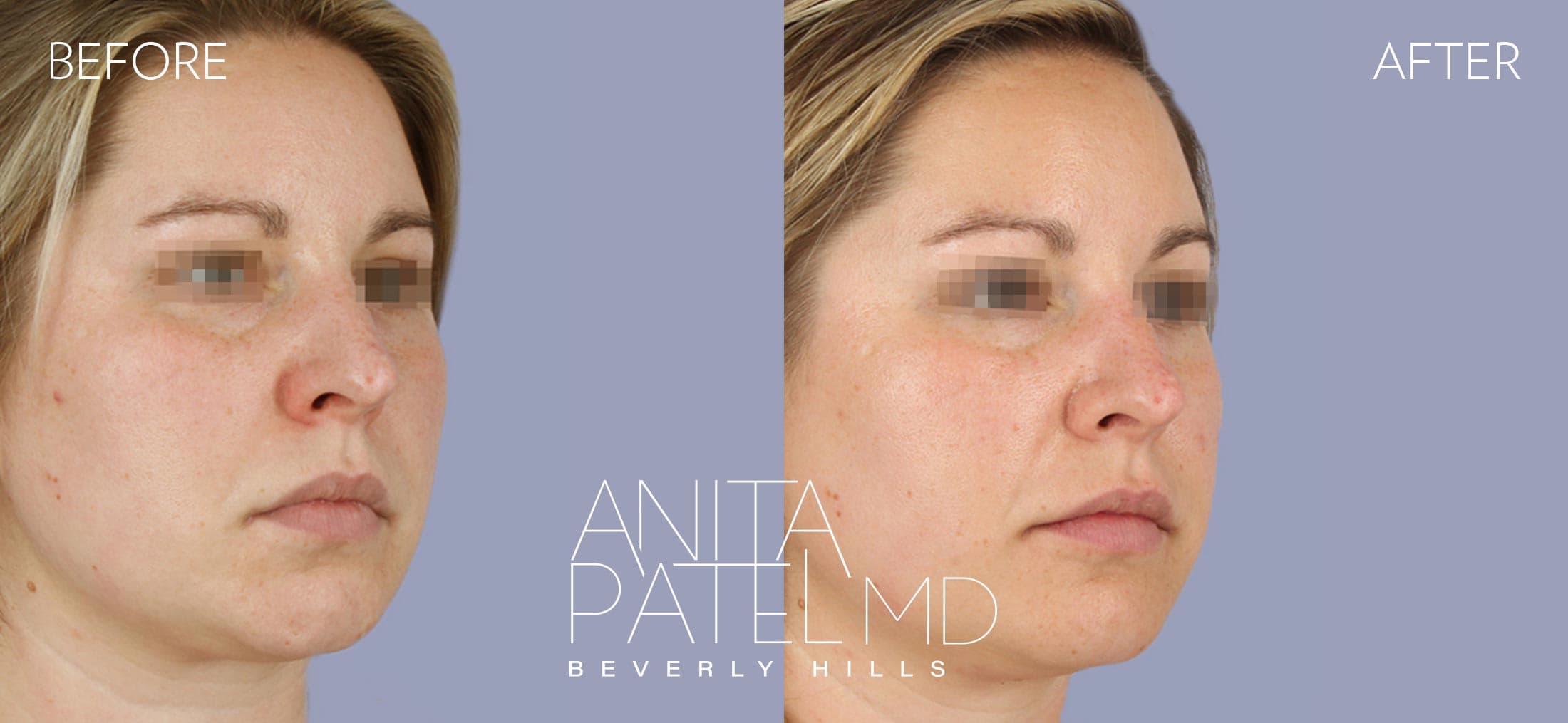 Dermal Fillers before and after — Patient 7, photo 2 of 2 — Dr. Anita Patel, MD, FACS, Beverly Hills