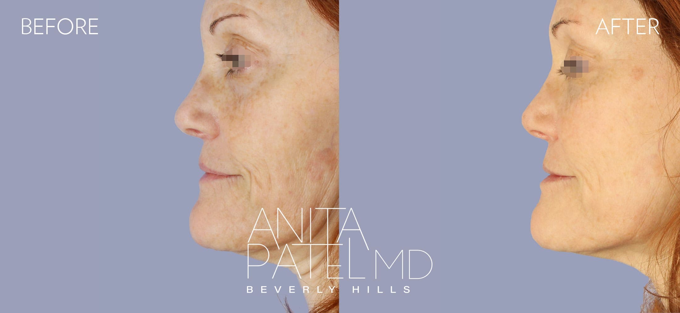 Liquid Makeover® before and after — Patient 8, photo 2 of 3 — Dr. Anita Patel, MD, FACS, Beverly Hills