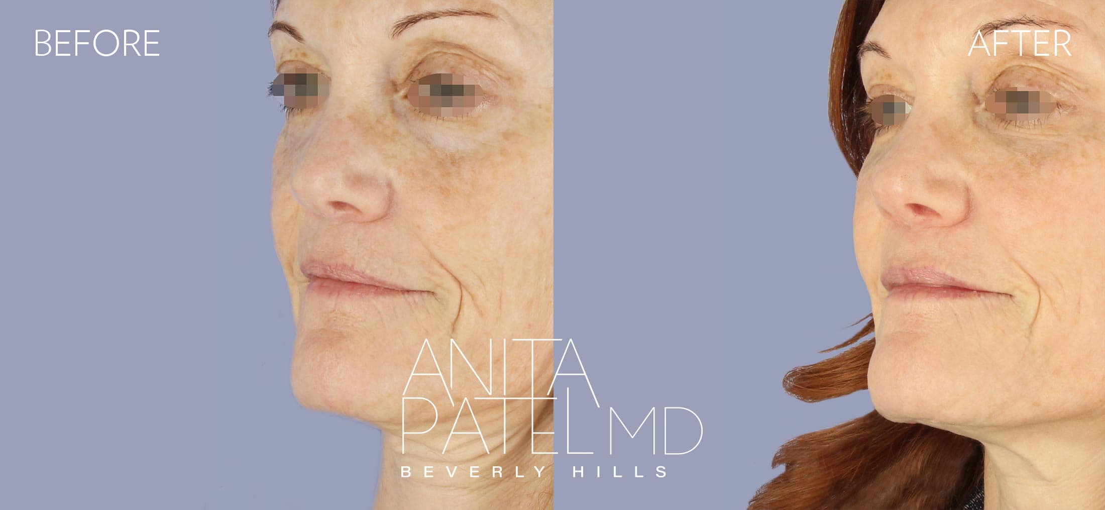 Liquid Makeover® before and after — Patient 8, photo 3 of 3 — Dr. Anita Patel, MD, FACS, Beverly Hills