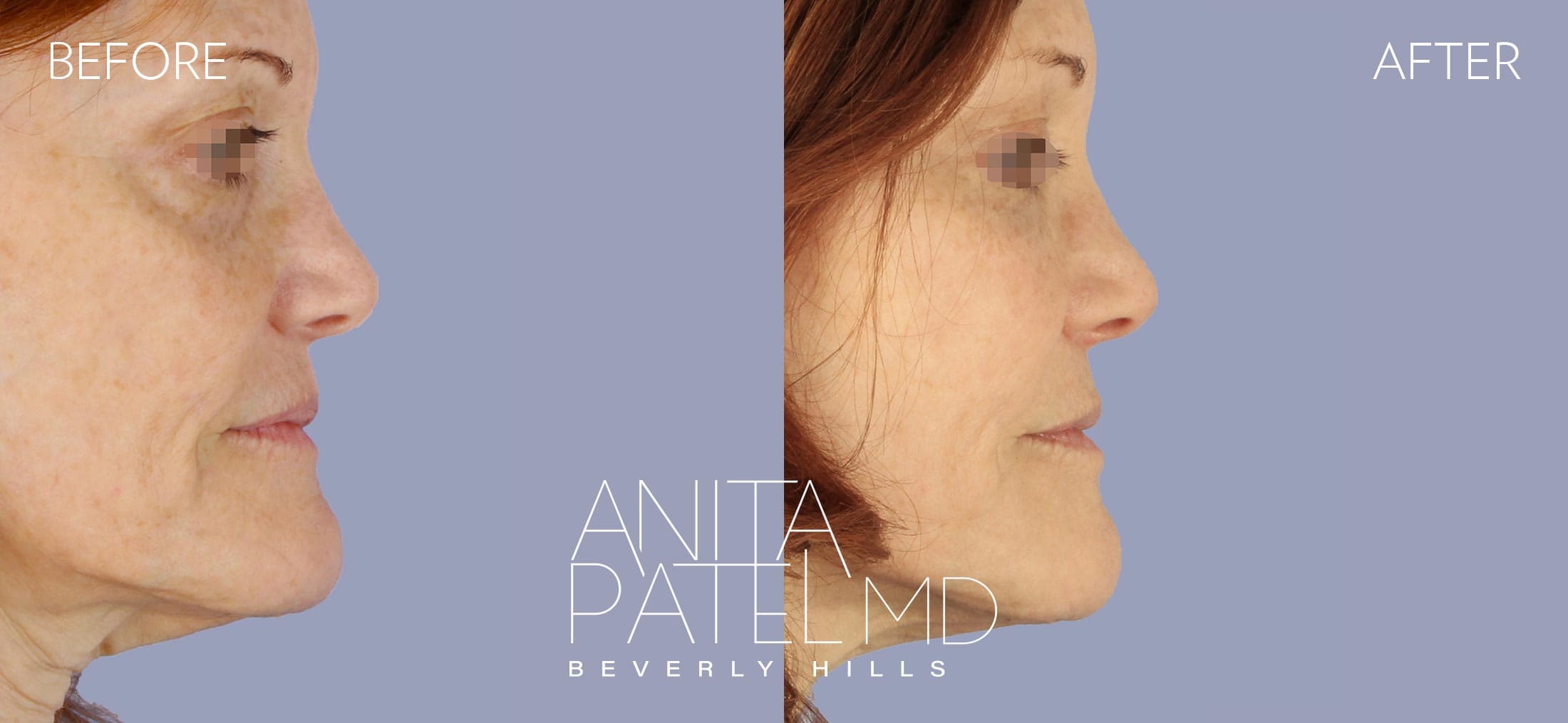 Liquid Makeover® before and after — Patient 8, photo 1 of 3 — Dr. Anita Patel, MD, FACS, Beverly Hills