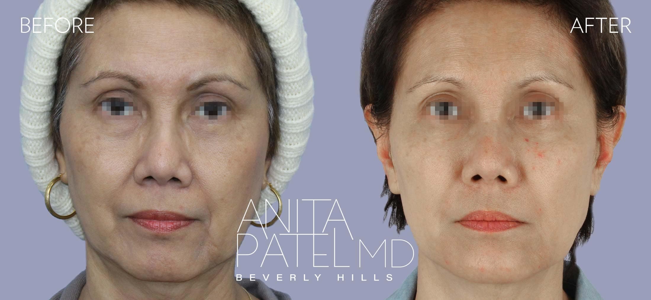 Dermal Fillers before and after — Patient 9, photo 1 of 5 — Dr. Anita Patel, MD, FACS, Beverly Hills