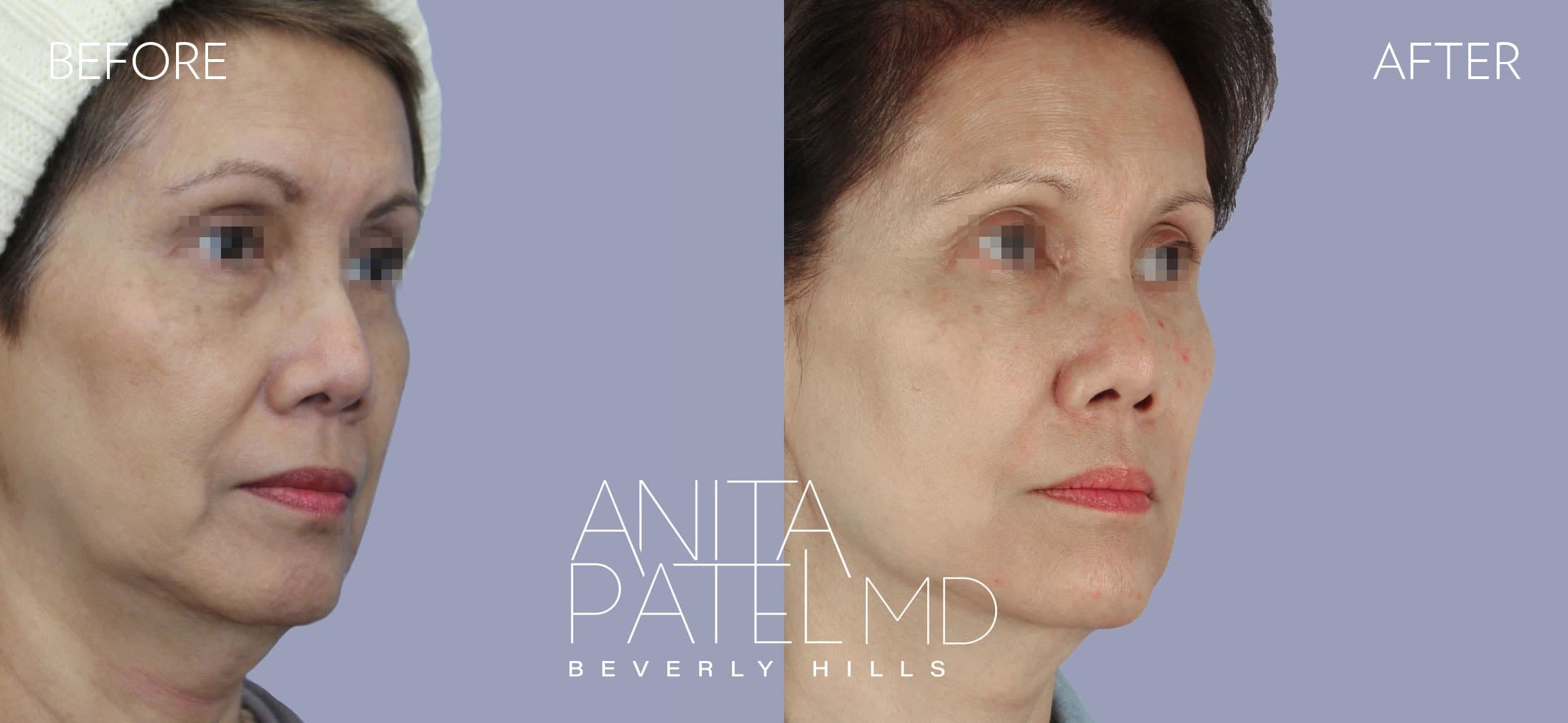 Dermal Fillers before and after — Patient 9, photo 2 of 5 — Dr. Anita Patel, MD, FACS, Beverly Hills