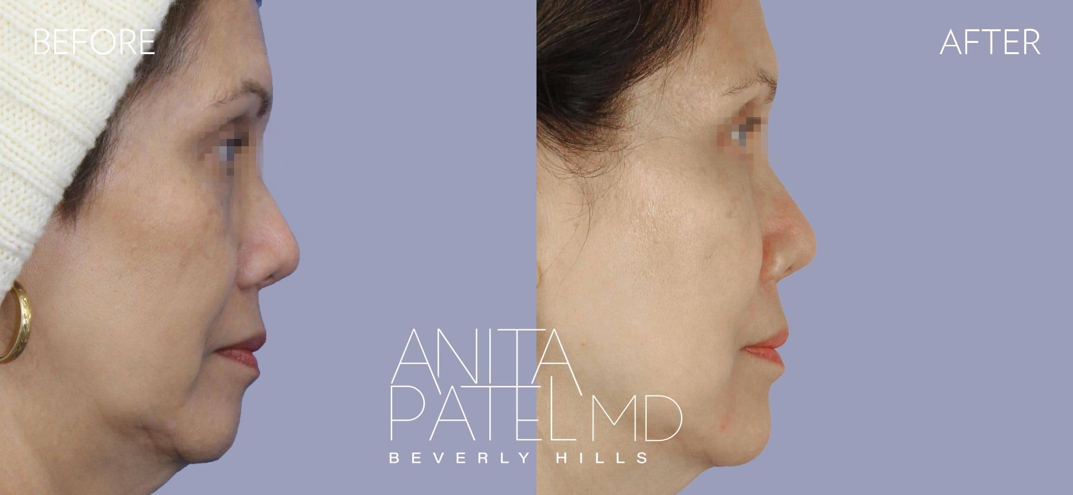 Dermal Fillers before and after — Patient 9, photo 3 of 5 — Dr. Anita Patel, MD, FACS, Beverly Hills