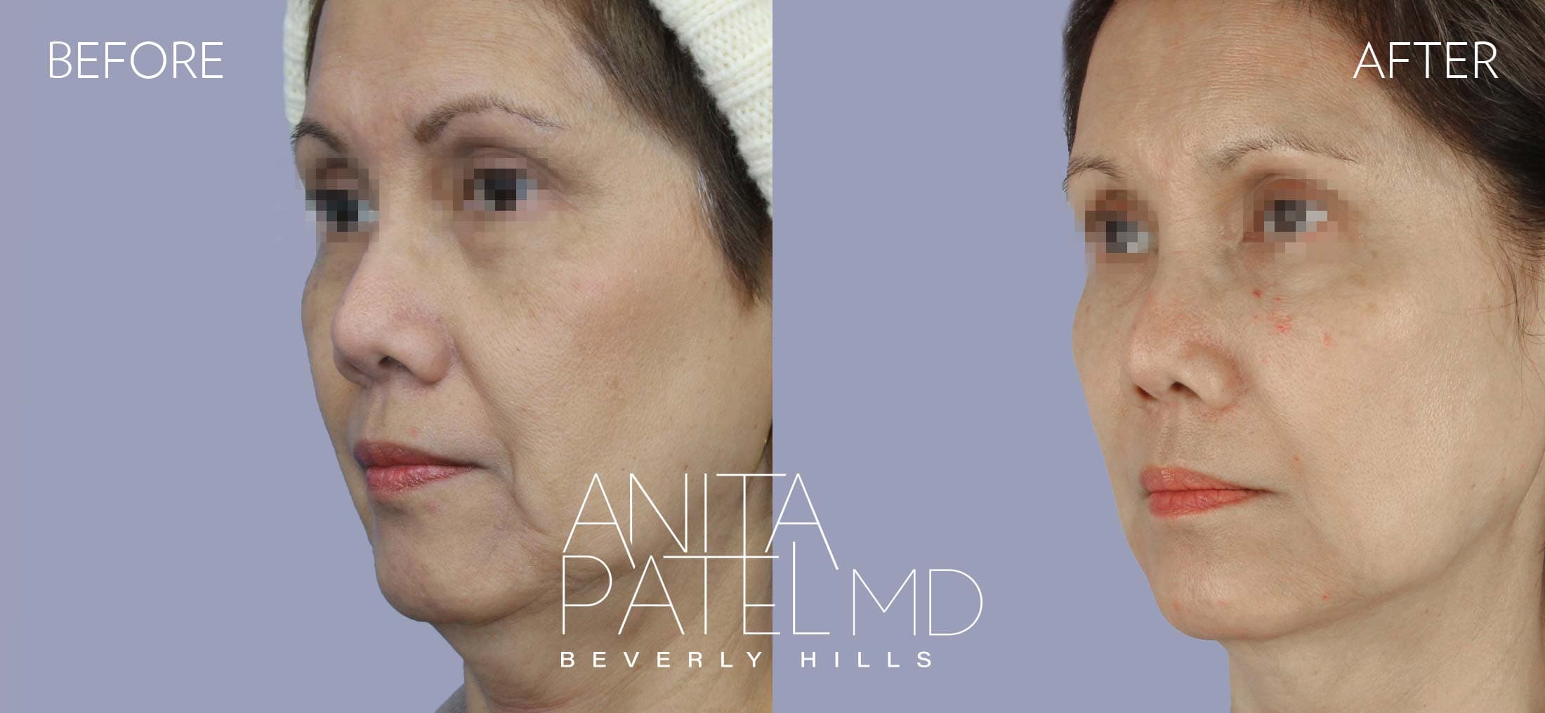 Dermal Fillers before and after — Patient 9, photo 4 of 5 — Dr. Anita Patel, MD, FACS, Beverly Hills