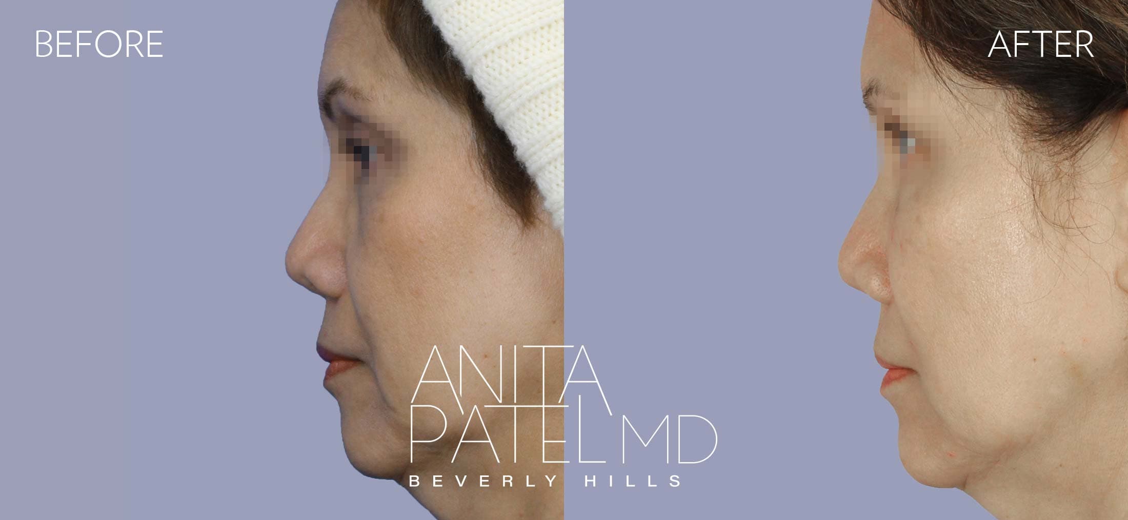 Dermal Fillers before and after — Patient 9, photo 5 of 5 — Dr. Anita Patel, MD, FACS, Beverly Hills