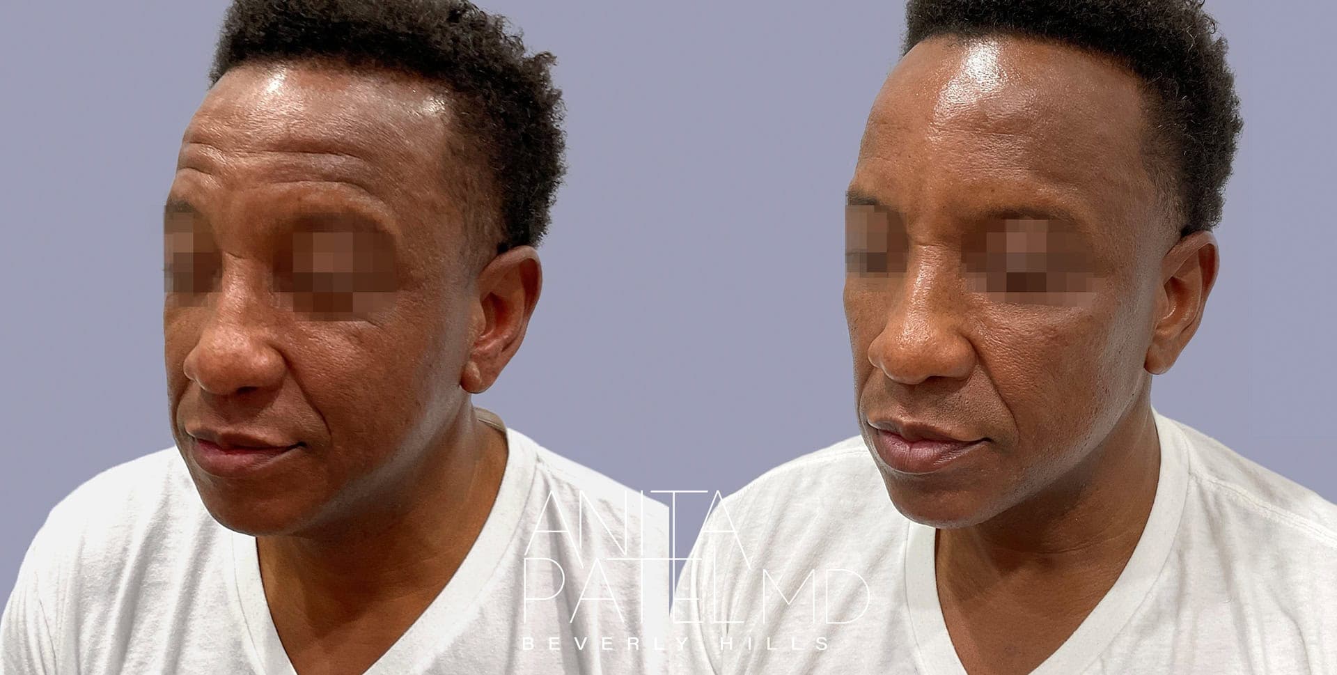 Liquid Makeover® before and after — Patient 3 — Dr. Anita Patel, MD, FACS, Beverly Hills
