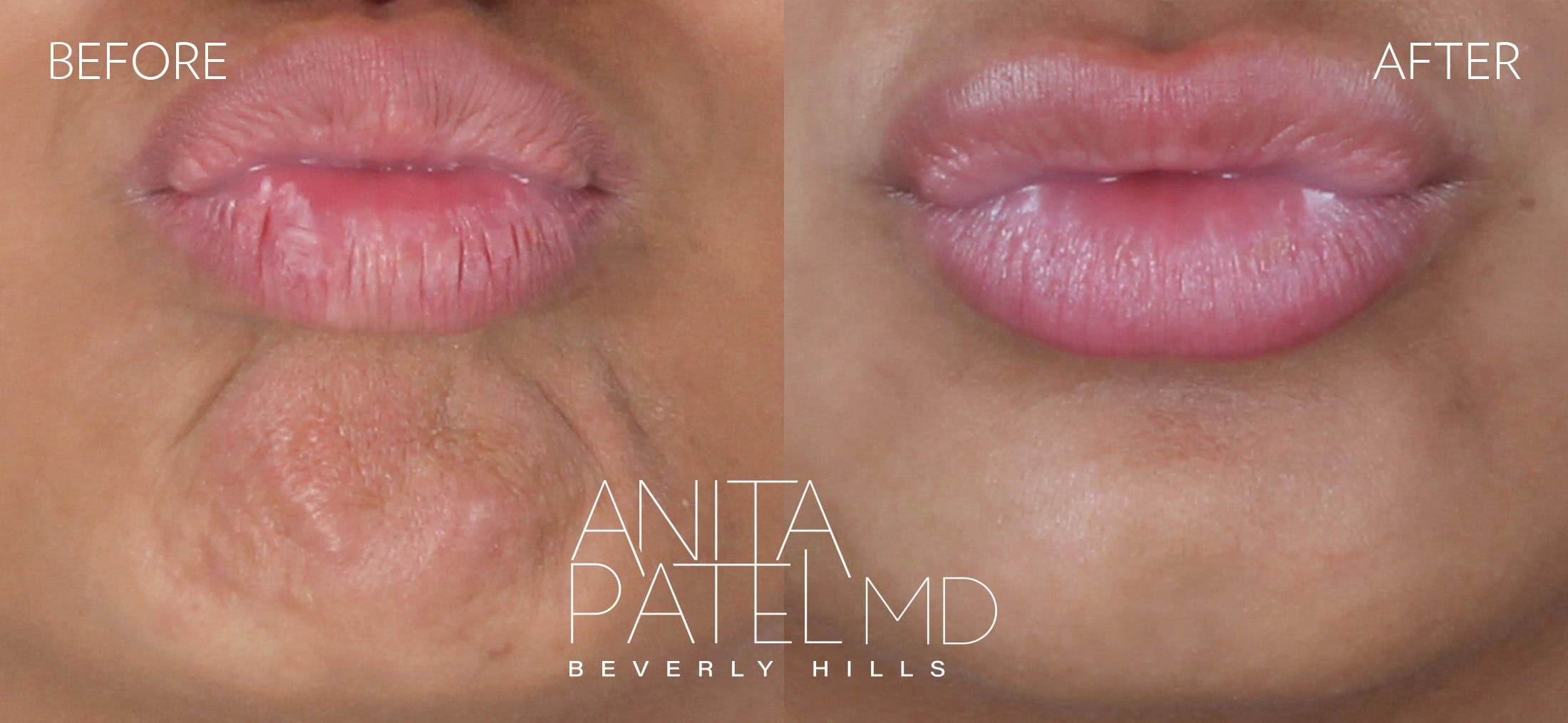 Neurotoxin before and after — Dr. Anita Patel, Beverly Hills