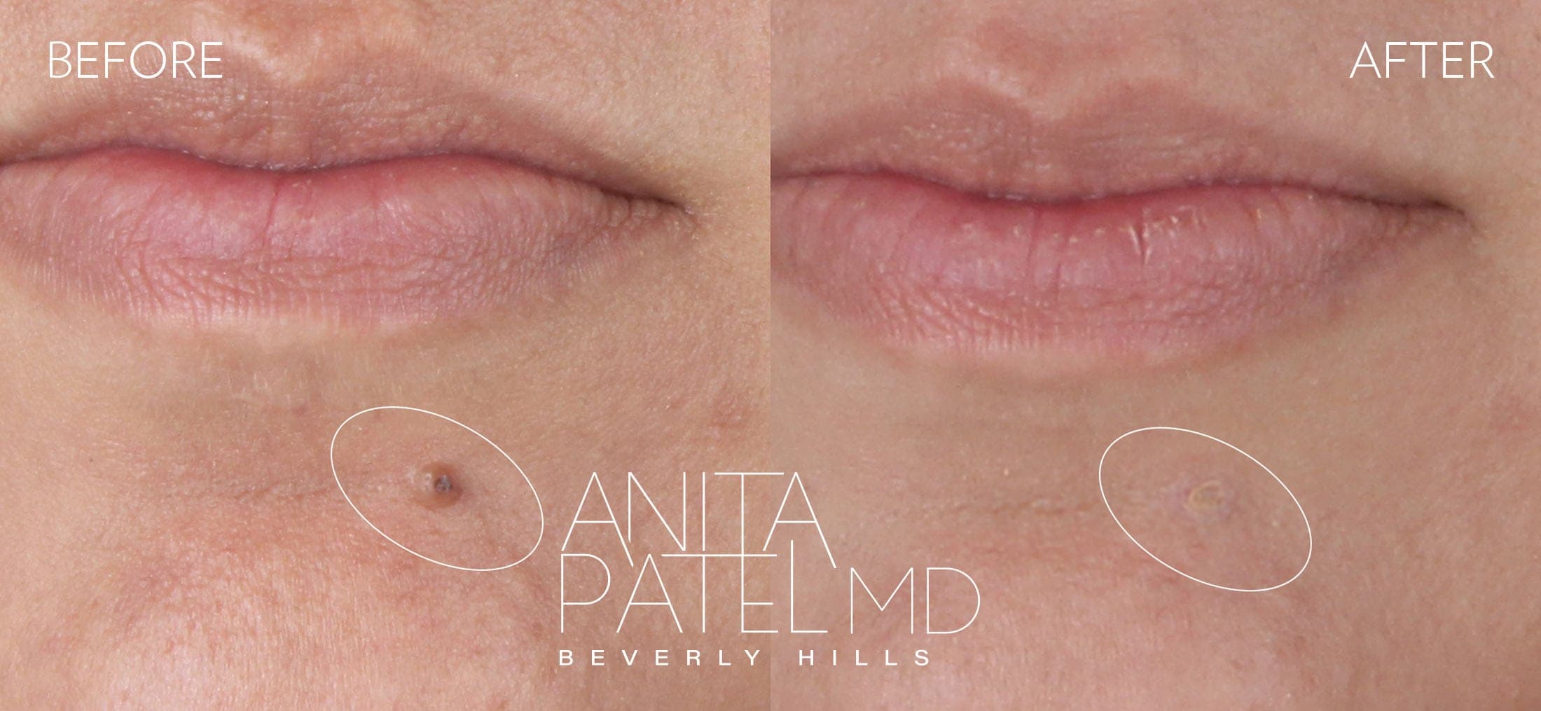 Mole Removal before and after — Patient Gallery, photo 1 of 4 — Dr. Anita Patel, MD, FACS, Beverly Hills