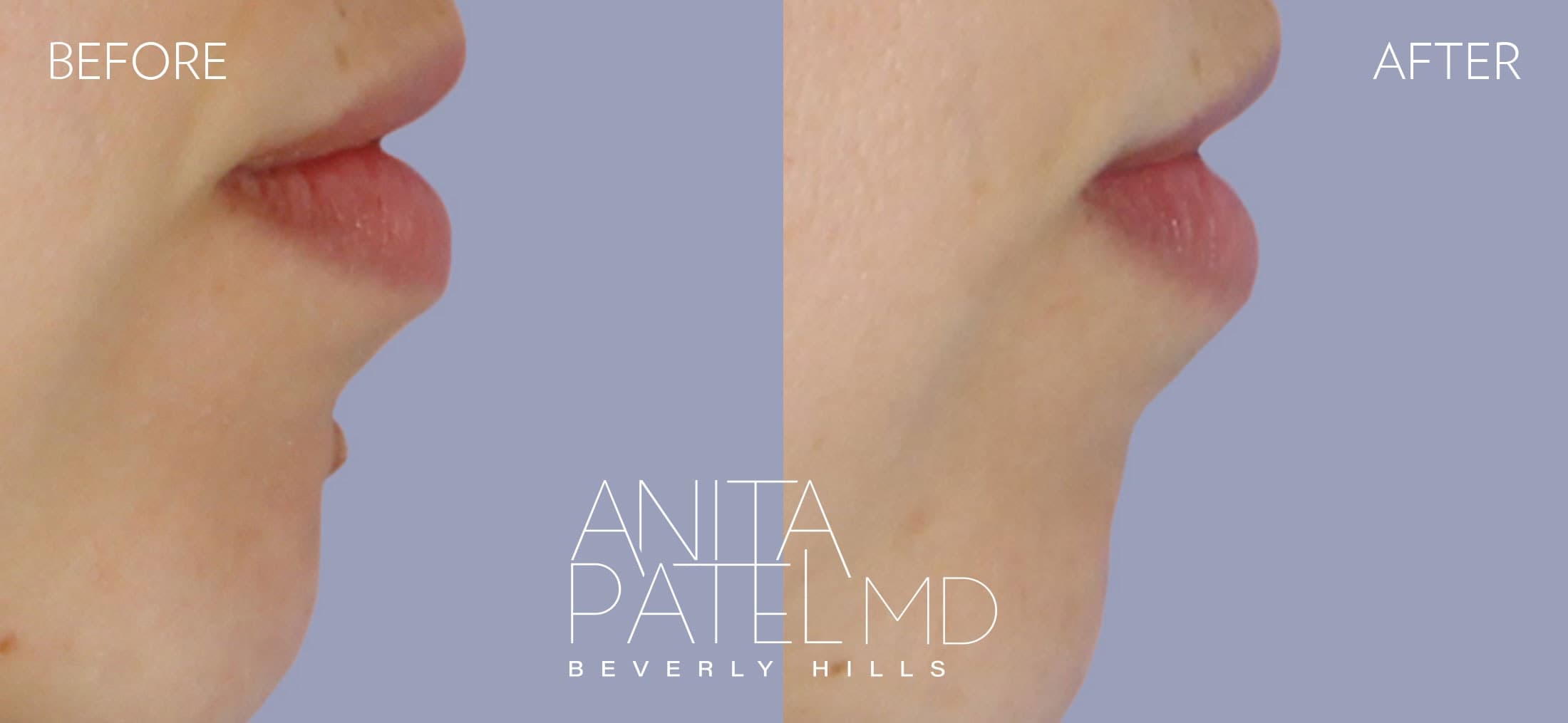 Mole Removal before and after — Patient Gallery, photo 2 of 4 — Dr. Anita Patel, MD, FACS, Beverly Hills