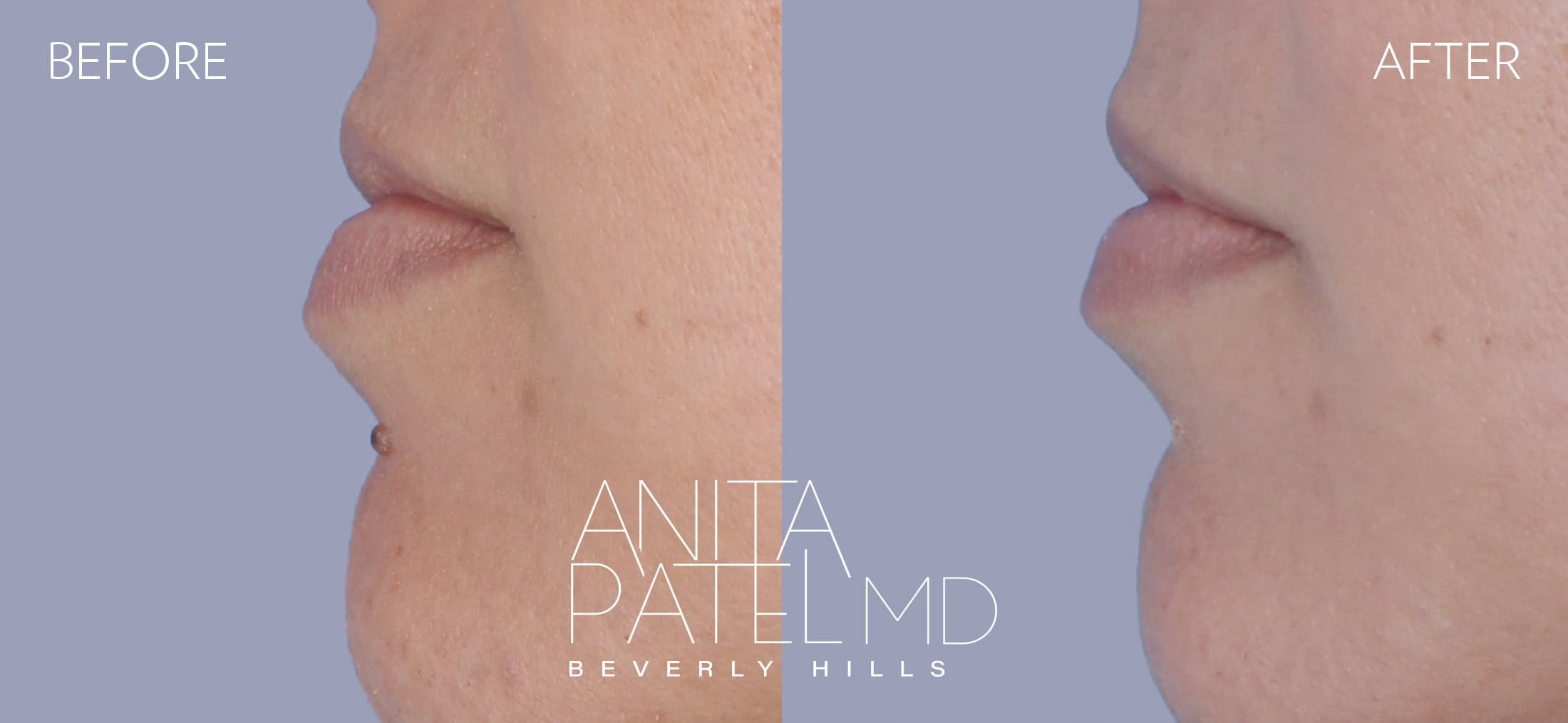 Mole Removal before and after — Patient Gallery, photo 3 of 4 — Dr. Anita Patel, MD, FACS, Beverly Hills