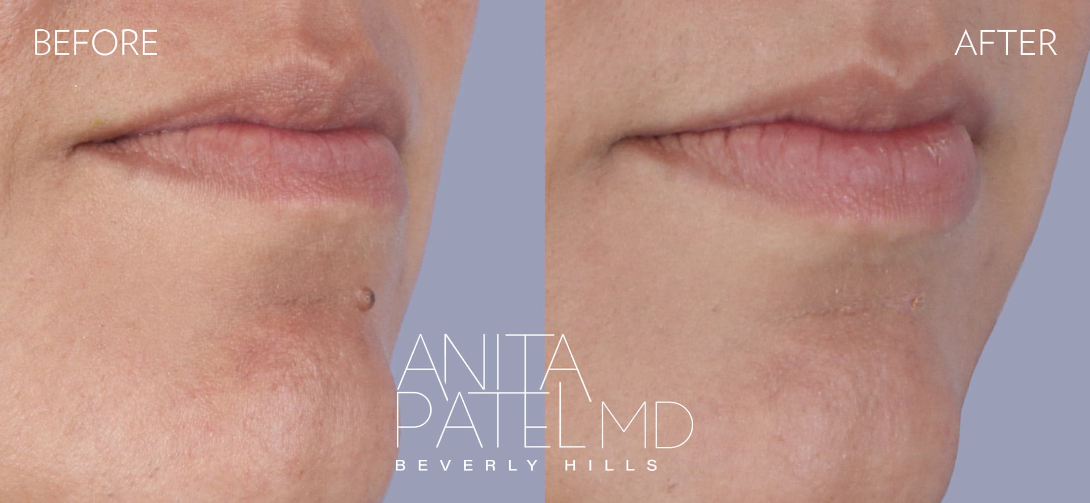 Mole Removal before and after — Patient Gallery, photo 4 of 4 — Dr. Anita Patel, MD, FACS, Beverly Hills