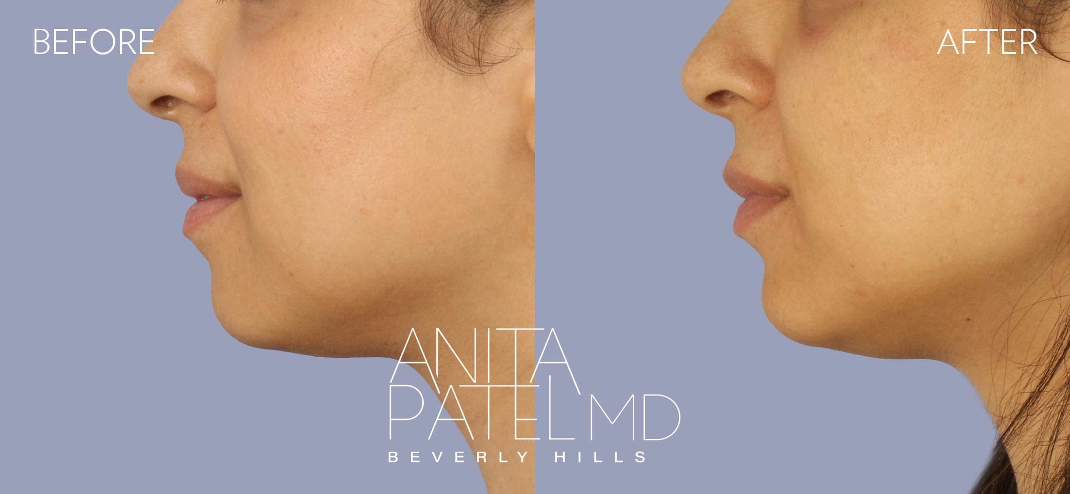 Dermal Fillers before and after — Patient 10, photo 2 of 2 — Dr. Anita Patel, MD, FACS, Beverly Hills