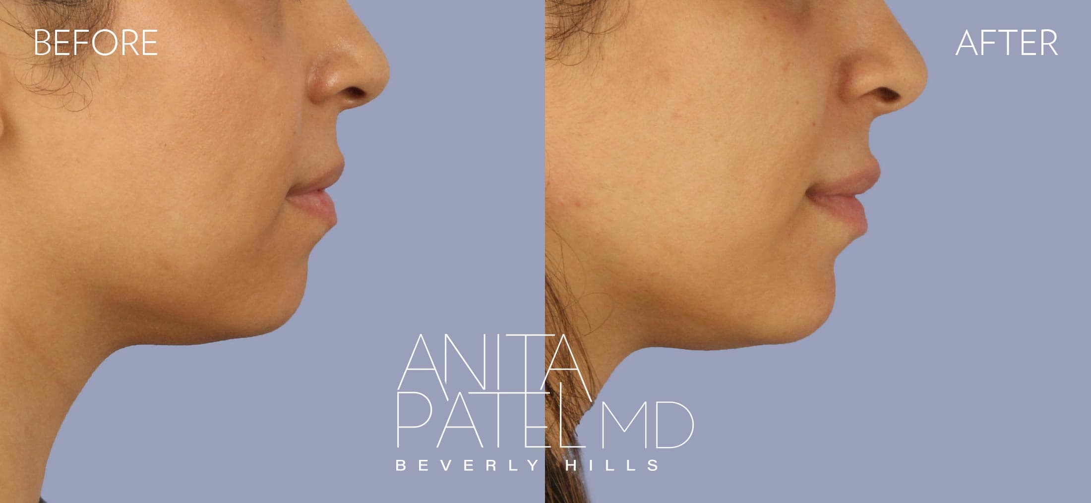 Dermal Fillers before and after — Patient 10, photo 1 of 2 — Dr. Anita Patel, MD, FACS, Beverly Hills