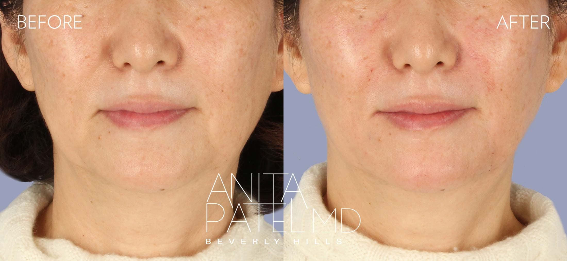 Dermal Fillers before and after — Patient 12, photo 1 of 5 — Dr. Anita Patel, MD, FACS, Beverly Hills