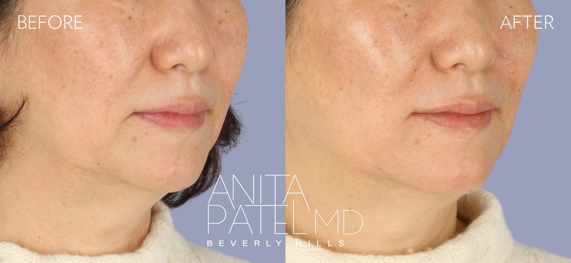 Dermal Fillers before and after — Patient 12, photo 2 of 5 — Dr. Anita Patel, MD, FACS, Beverly Hills