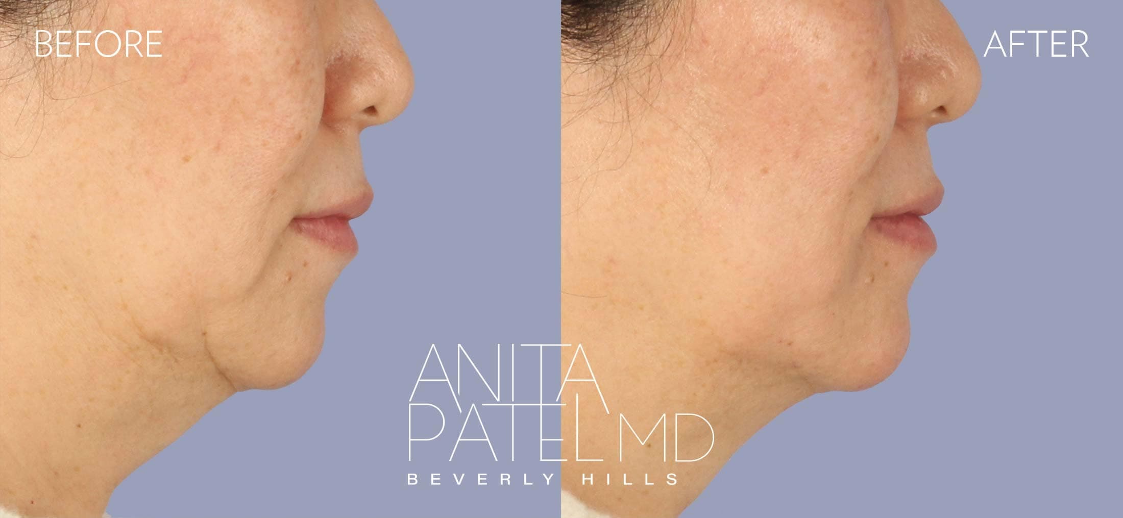 Dermal Fillers before and after — Patient 12, photo 3 of 5 — Dr. Anita Patel, MD, FACS, Beverly Hills