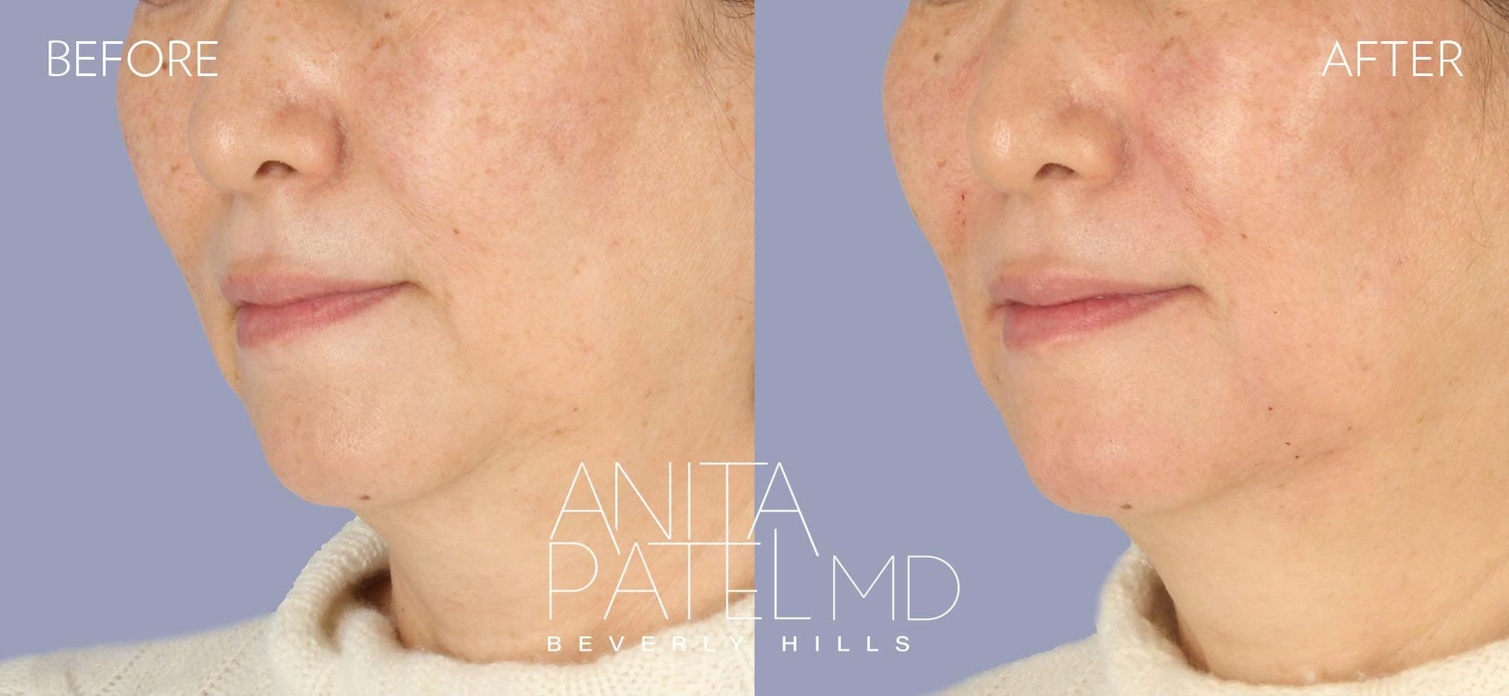 Dermal Fillers before and after — Patient 12, photo 4 of 5 — Dr. Anita Patel, MD, FACS, Beverly Hills