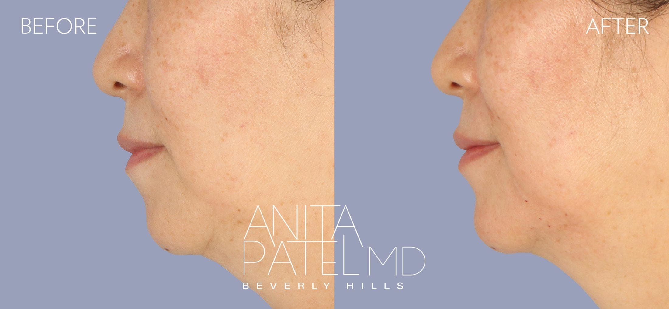 Dermal Fillers before and after — Patient 12, photo 5 of 5 — Dr. Anita Patel, MD, FACS, Beverly Hills