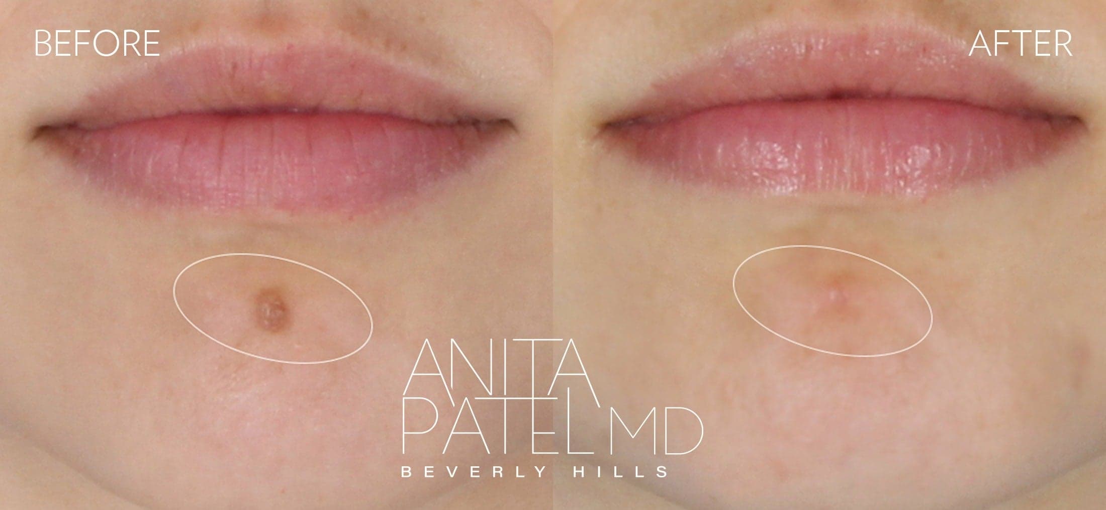 Mole Removal before and after — Patient Gallery — Dr. Anita Patel, MD, FACS, Beverly Hills