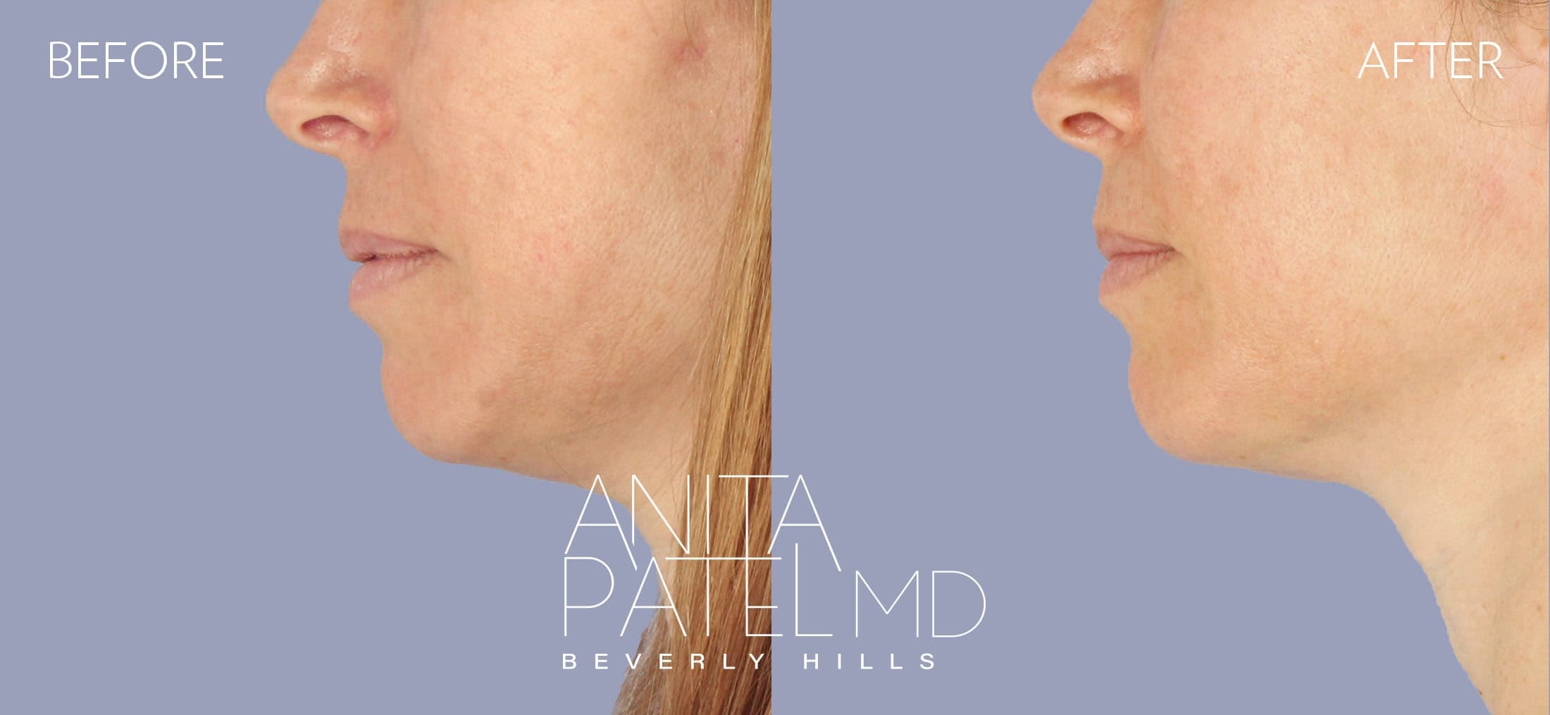 Dermal Fillers before and after — Patient 1 — Dr. Anita Patel, MD, FACS, Beverly Hills
