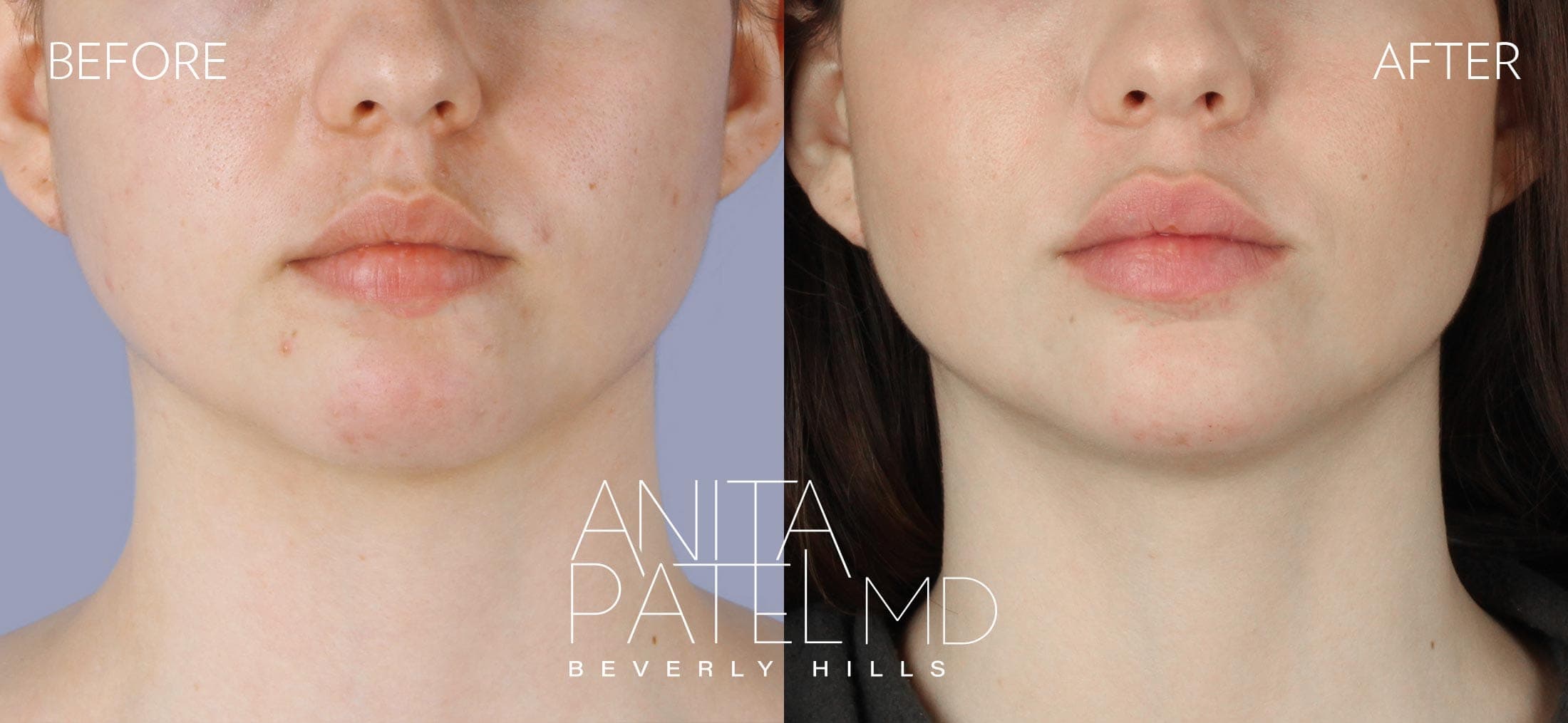 Dermal Fillers before and after — Patient 3, photo 1 of 5 — Dr. Anita Patel, MD, FACS, Beverly Hills