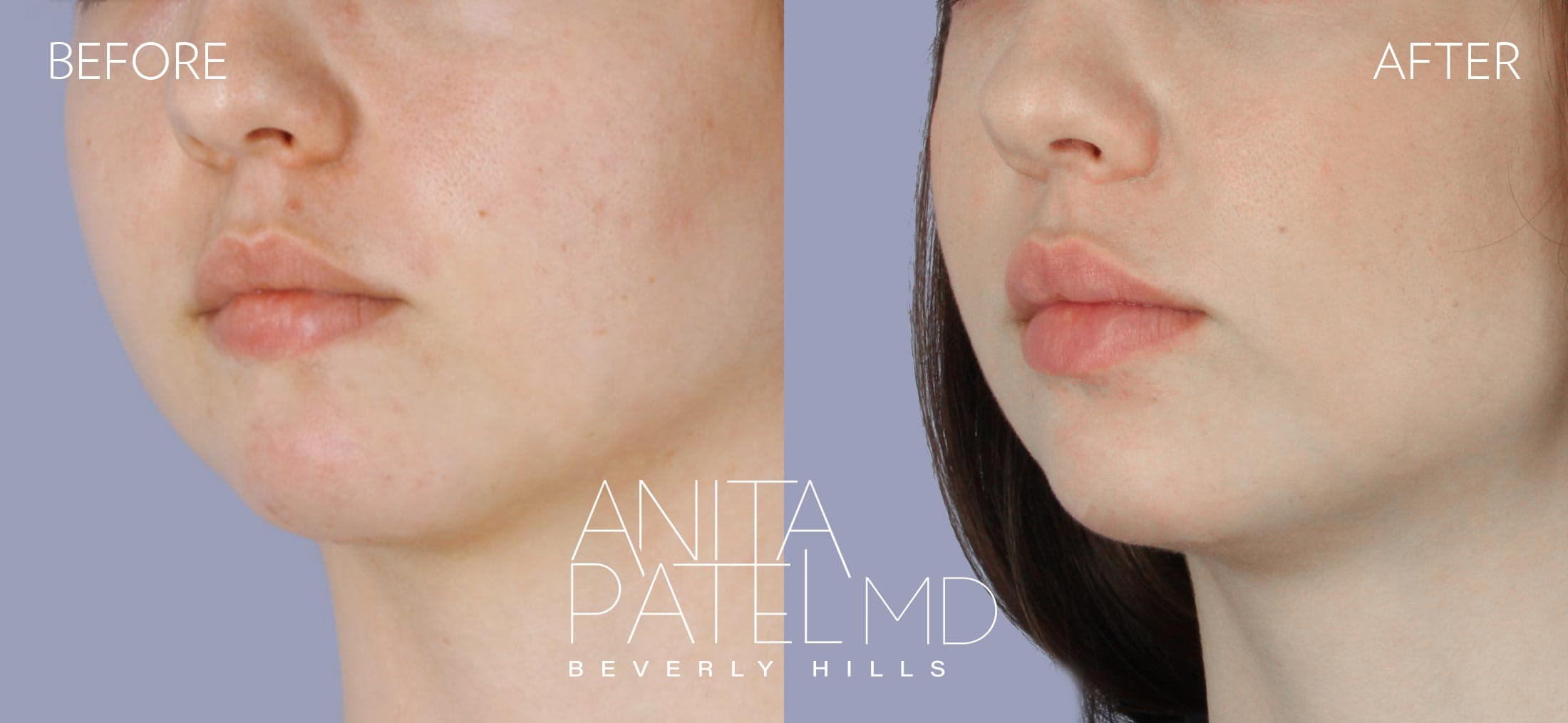 Dermal Fillers before and after — Patient 3, photo 3 of 5 — Dr. Anita Patel, MD, FACS, Beverly Hills