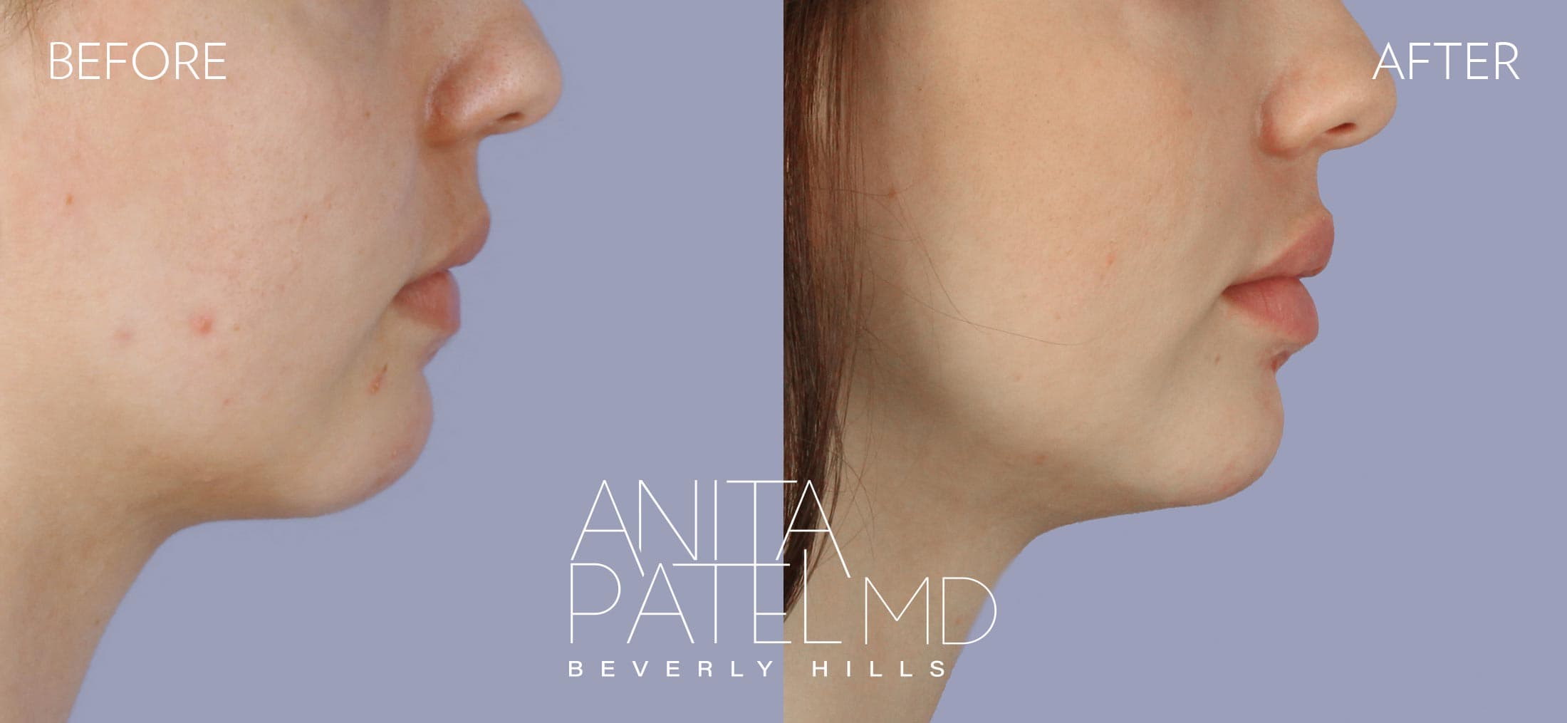 Dermal Fillers before and after — Patient 3, photo 4 of 5 — Dr. Anita Patel, MD, FACS, Beverly Hills