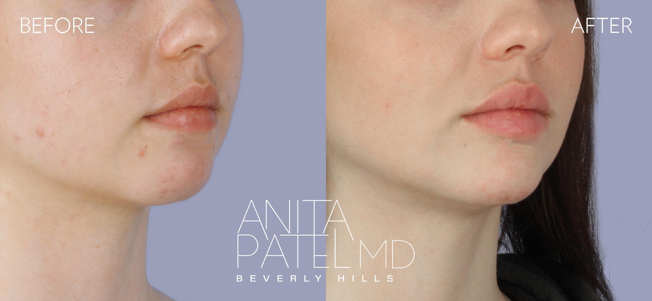 Dermal Fillers before and after — Patient 3, photo 5 of 5 — Dr. Anita Patel, MD, FACS, Beverly Hills