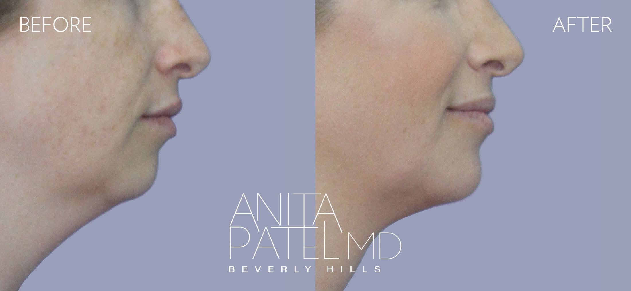 Dermal Fillers before and after — Patient 3, photo 2 of 5 — Dr. Anita Patel, MD, FACS, Beverly Hills