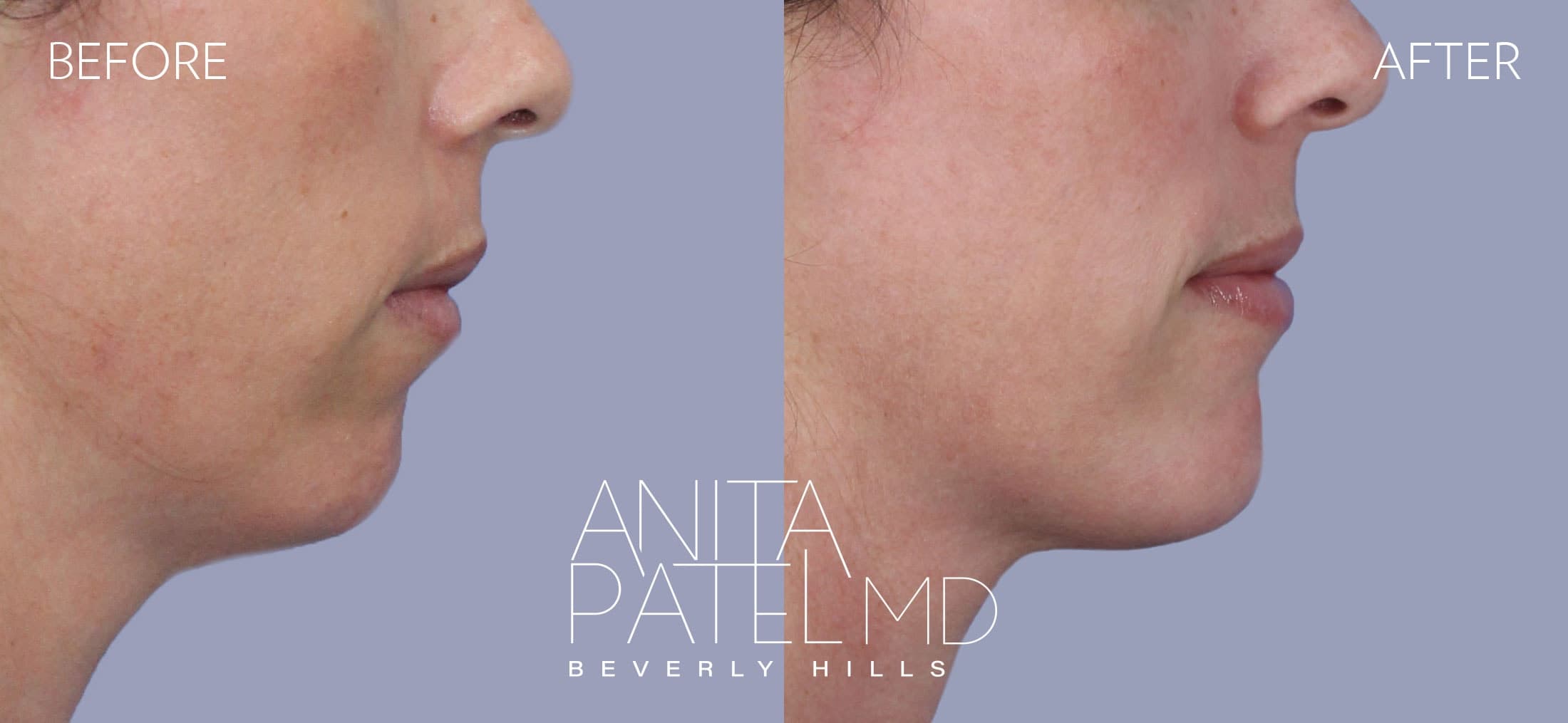 Dermal Fillers before and after — Patient 4, photo 2 of 2 — Dr. Anita Patel, MD, FACS, Beverly Hills