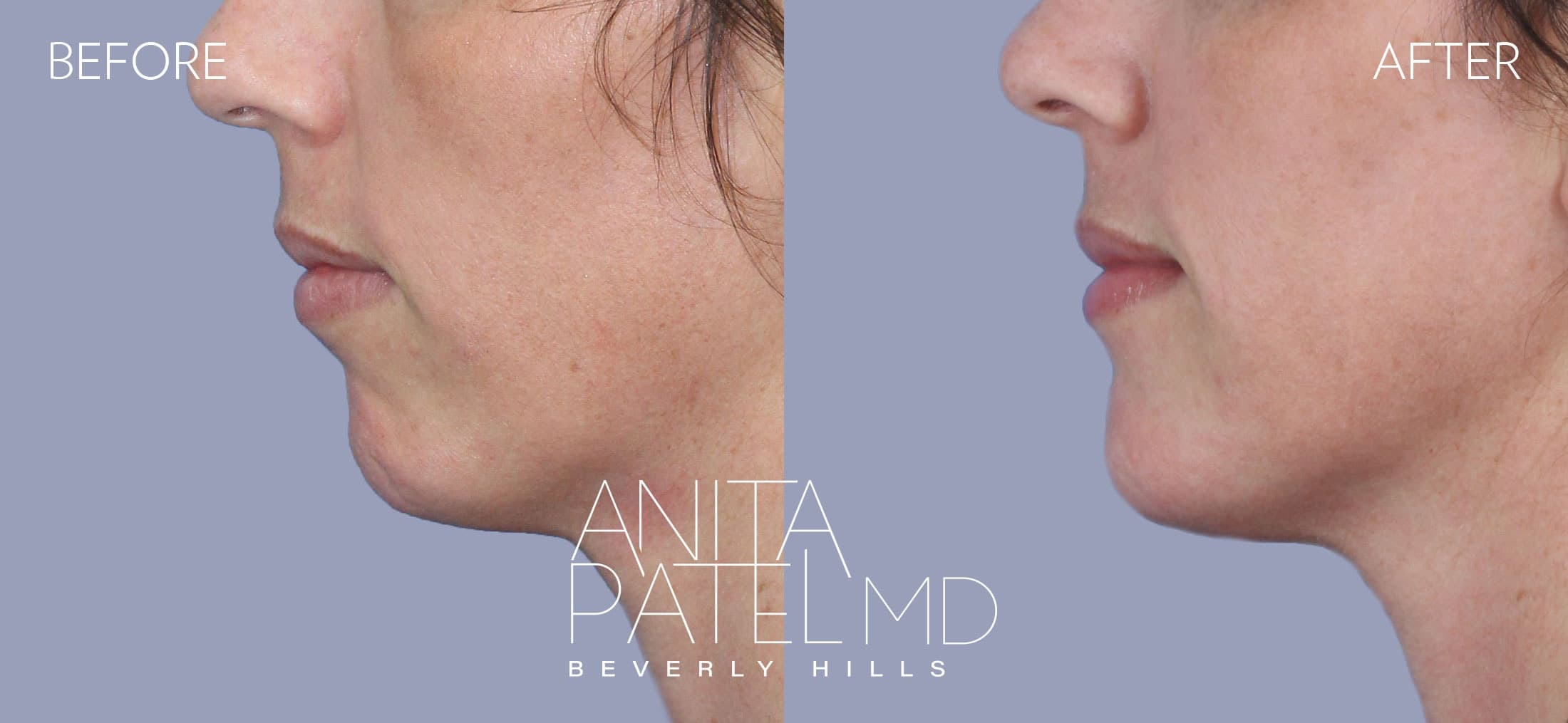 Dermal Fillers before and after — Patient 4, photo 1 of 2 — Dr. Anita Patel, MD, FACS, Beverly Hills