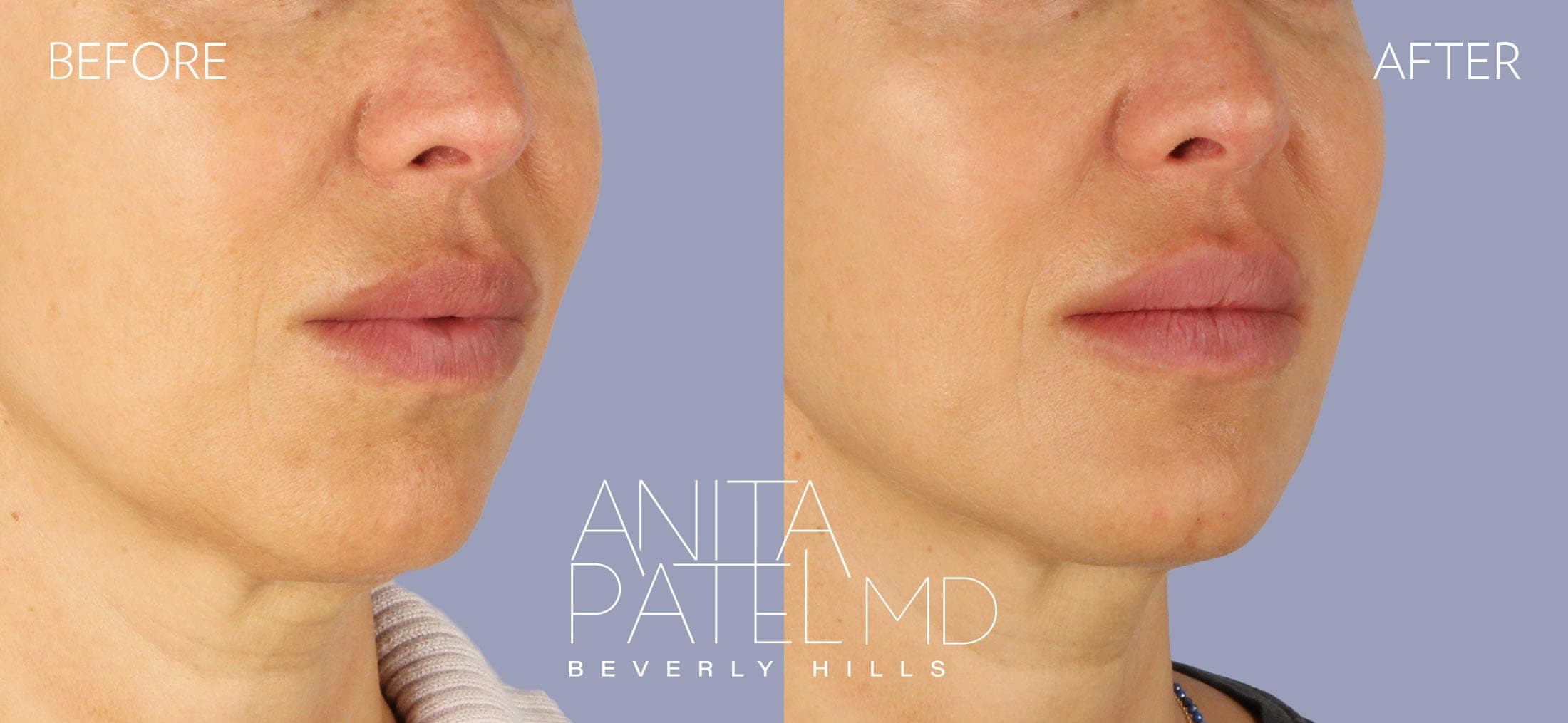 Dermal Fillers before and after — Patient 5, photo 1 of 4 — Dr. Anita Patel, MD, FACS, Beverly Hills