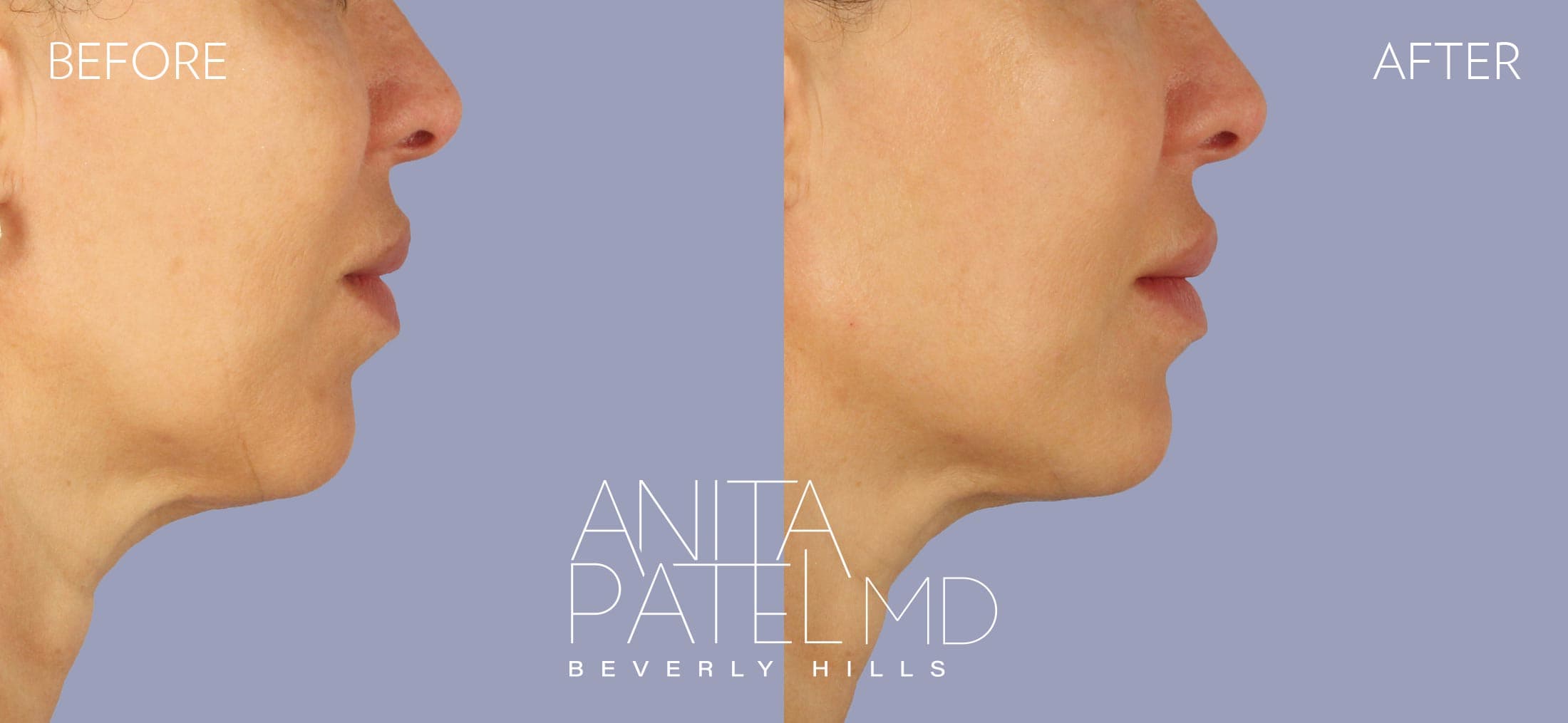 Dermal Fillers before and after — Patient 5, photo 2 of 4 — Dr. Anita Patel, MD, FACS, Beverly Hills